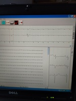 Holter EKG
